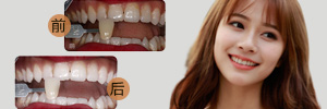 美白案例