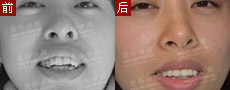 欧式无痛种植牙