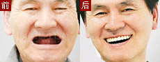 英式四维矫正