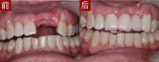 纯欧仿生美容冠