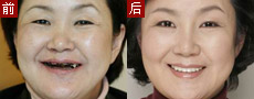 牙齿美白